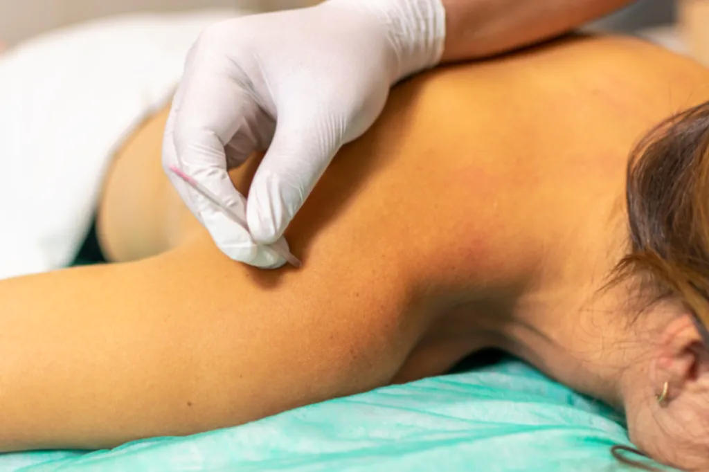 Dry Needling + Exercise Therapy