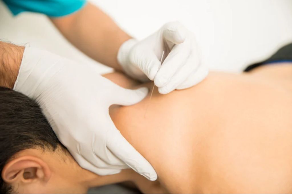 Dry Needling Physiotherapy